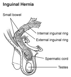 Inguinal hernia - Wikipedia