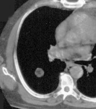 Lung Hamartoma Imaging: Practice Essentials, Radiography, Computed Tomography