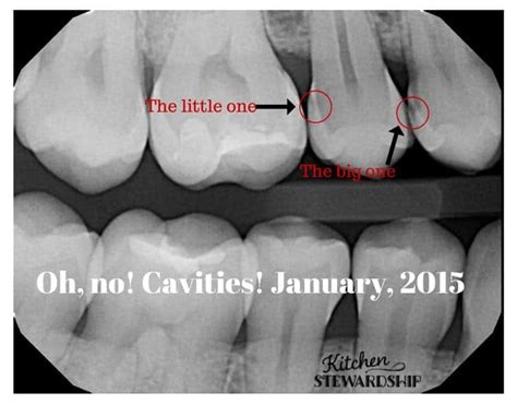 Reversing Cavities Is Truly Possible! Teeth Can Heal!