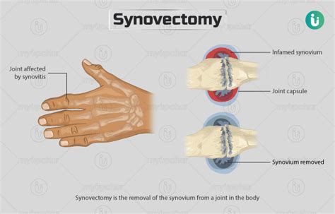 Synovectomy: Procedure, Purpose, Results, Cost, Price