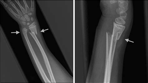 Child With Dinner Fork Deformity - Annals of Emergency Medicine