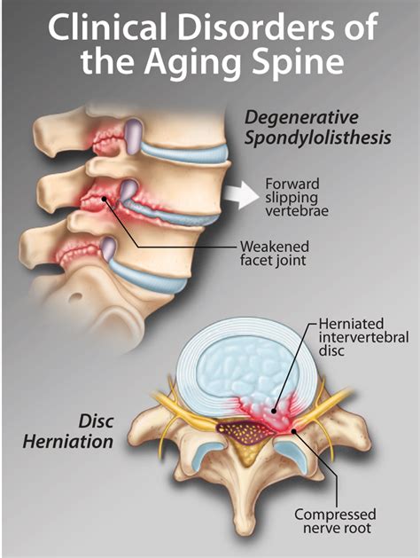 neurogenic claudication | healthPlexus.net