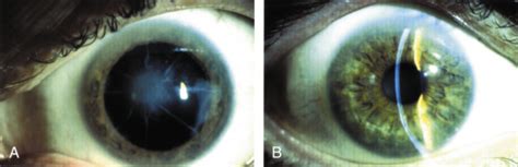 Phototherapeutic Keratectomy (PTK) and Intralamellar PTK | Ento Key