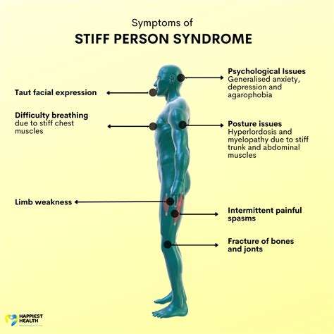 Stiff-person syndrome - HughenaLoukas