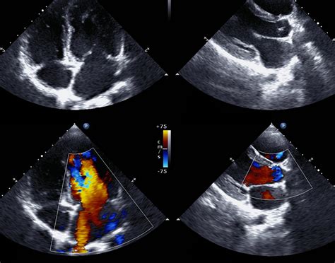 Echocardiogram