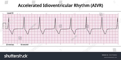 9 Accelerated Idioventricular Images, Stock Photos, 3D objects ...