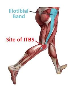 Lateral Knee Pain: Causes & Treatment - Knee Pain Explained