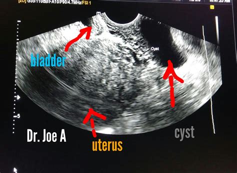 Gartner Cyst Ultrasound