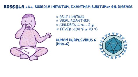 Roseola (Exanthem subitum): Nursing - Osmosis Video Library