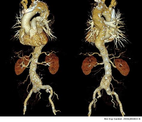 Cuantificación del calcio aórtico y arteriosclerosis vascular en individuos asintomáticos: más ...