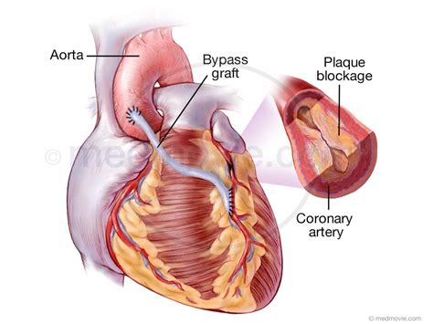 Coronary Artery Bypass Graft – Medmovie.com