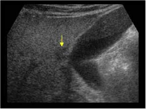 Abdomen and retroperitoneum | 1.1 Liver : Case 1.1.11 Fatty liver and focal sparing | Ultrasound ...