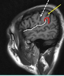 Central sulcus – Radiology Cases