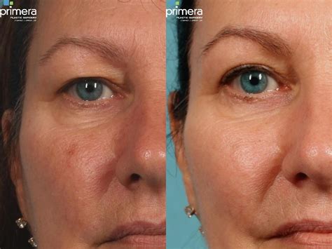 Blepharoplasty Before and After Pictures Case 288 | Orlando, Florida | Primera Plastic Surgery