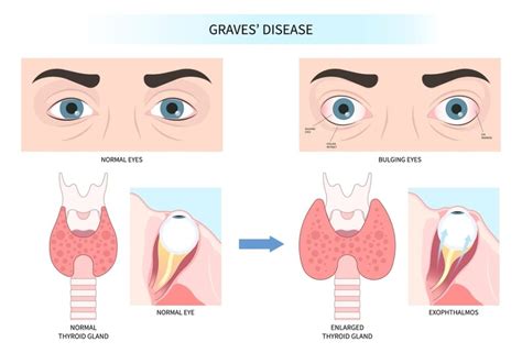 Graves Disease VA Rating Explained