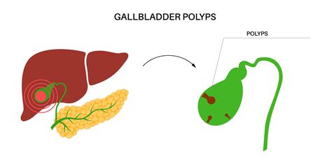 What To Do About Gallbladder Polyps | Cabot Health