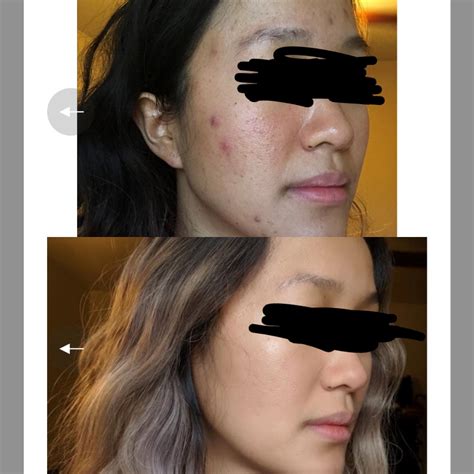 After 1 year of being on spironolactone! : r/acne