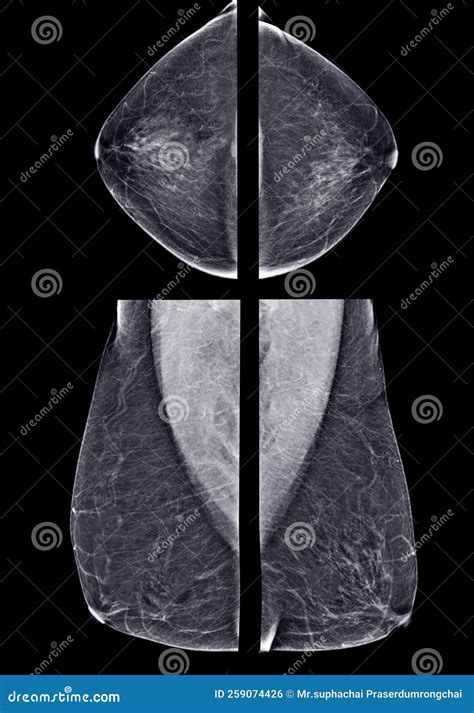 X-ray Digital Mammogram Or Mammography Of Both Side Breast Standard ...