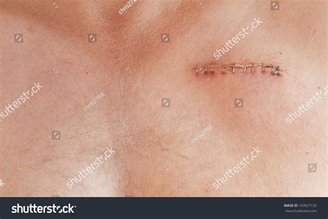 Pacemaker Scar On A Male Aged 45 Stock Photo 107627132 : Shutterstock