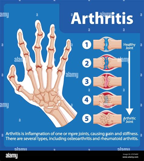 Illustrated infographic showcasing stages of arthritis in the human hand Stock Vector Image ...