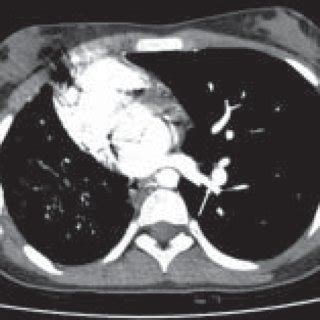 Left pulmonary vein ending into left atrium is well visualized... | Download Scientific Diagram