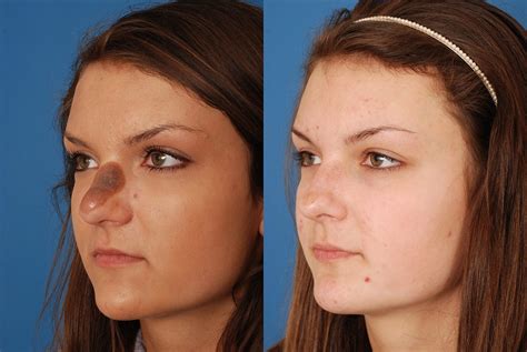 SKIN-LESION-REMOVAL-1 – Dallas Advanced Facial Plastic Surgery Center