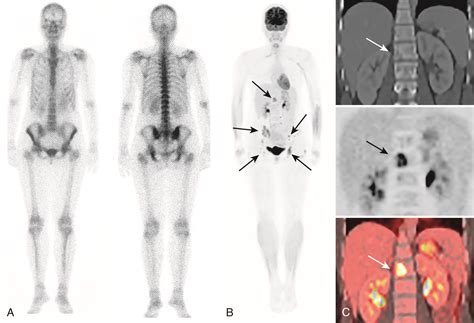 Breast Cancer Metastases-Bone | PracticeUpdate