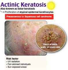 Actinic Keratosis Vs Skin Cancer