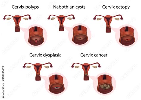 Cervical diseases. Cervix polyps, ectopy, dysplasia, cancer, nabothian cysts. Medical anatomy ...