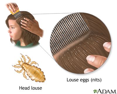 Head lice: MedlinePlus Medical Encyclopedia