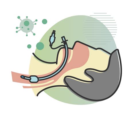 A Brief History of the Endotracheal Tube | Emergency Physicians Monthly