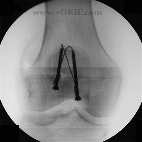 Patella Fracture ORIF 27524 | eORIF