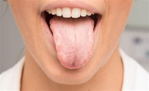 What Causes Dry Mouth & How To Relieve It | SmartMouth