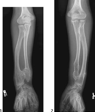 114 Multiple Hereditary Exostoses | Radiology Key