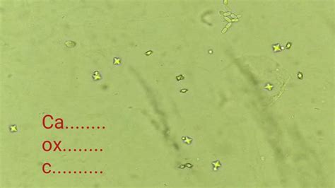 calcium oxalate crystals | budding yeast cells in urine | calcium oxalate under microscope - YouTube