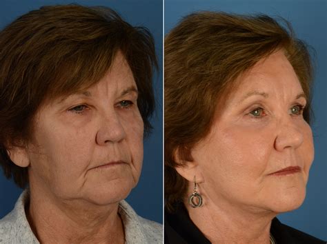 Blepharoplasty, Endoscopic Facelift Photos | Naples, FL | Patient 12698