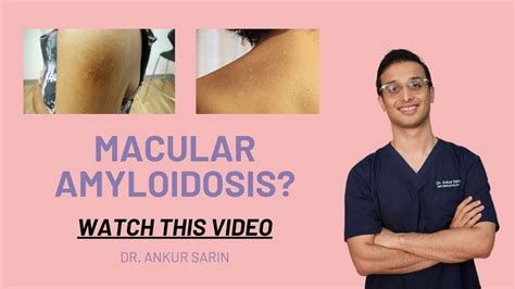 Macular Amyloidosis Skin Treatment | Macular amyloidosis Hindi | Dr ...