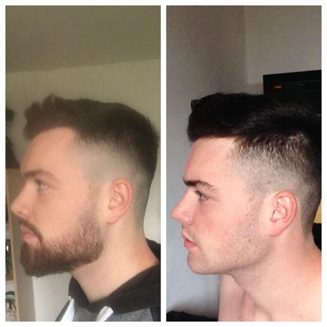 Minoxidil Beard Before And After Pictures