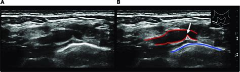 | Longitudinal ultrasound view of the right subclavian artery at the... | Download Scientific ...