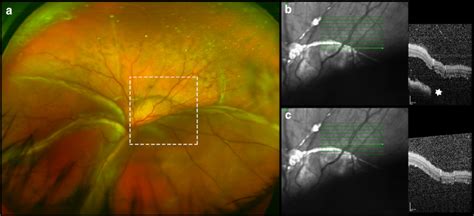 Showing imaging performed in a patient with an exudative retinal ...