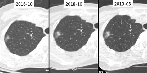 Letter to the Editor Regarding “Long-Term Follow-Up of Ground-Glass Nodules After 5 Years of ...