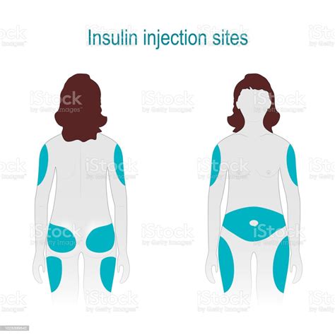 Printable Chart For Insulin Injection Sites - Free Printable Charts