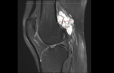 Incidental Ganglion Cyst Finding on an MRI for a knee injury : r/Radiology