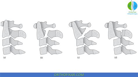 Hangman's Fracture | OrthoFixar 2024