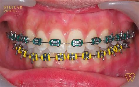 Braces Colors: Top Picks For 2023 - Stellar Dental