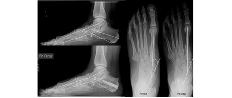 Radiological lateral view of a stage II adult-acquired flatfoot of... | Download Scientific Diagram