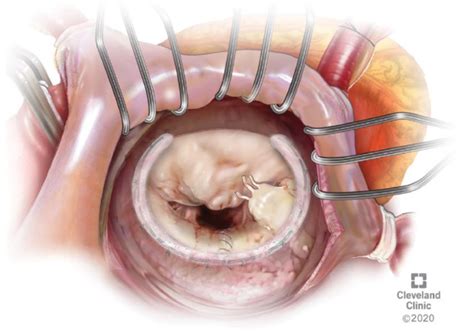 Techniques for Mitral Valve Re-repair - Operative Techniques in ...