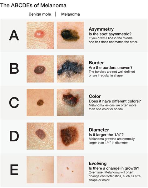 Skin Cancer Screening | New York Dermatology Group