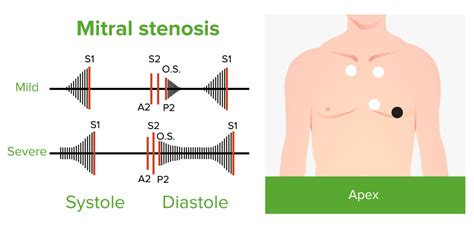 Mitral Stenosis | Concise Medical Knowledge