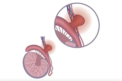 Spermatocele (Epididymal Cyst): Symptoms, Causes, Treatment – My Health ...